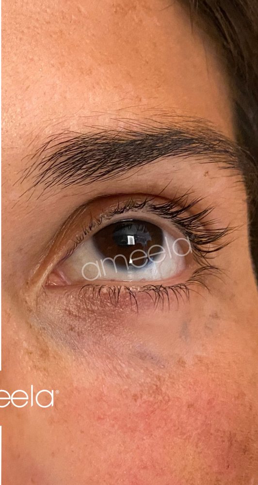 After: Ameela Eyes · under-eye