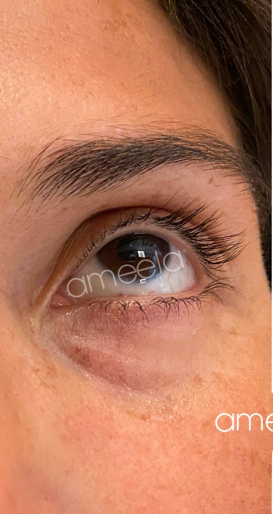 Before: Ameela Eyes · under-eye