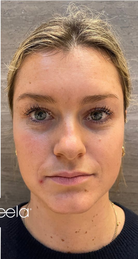 After: Ameela Face · full face