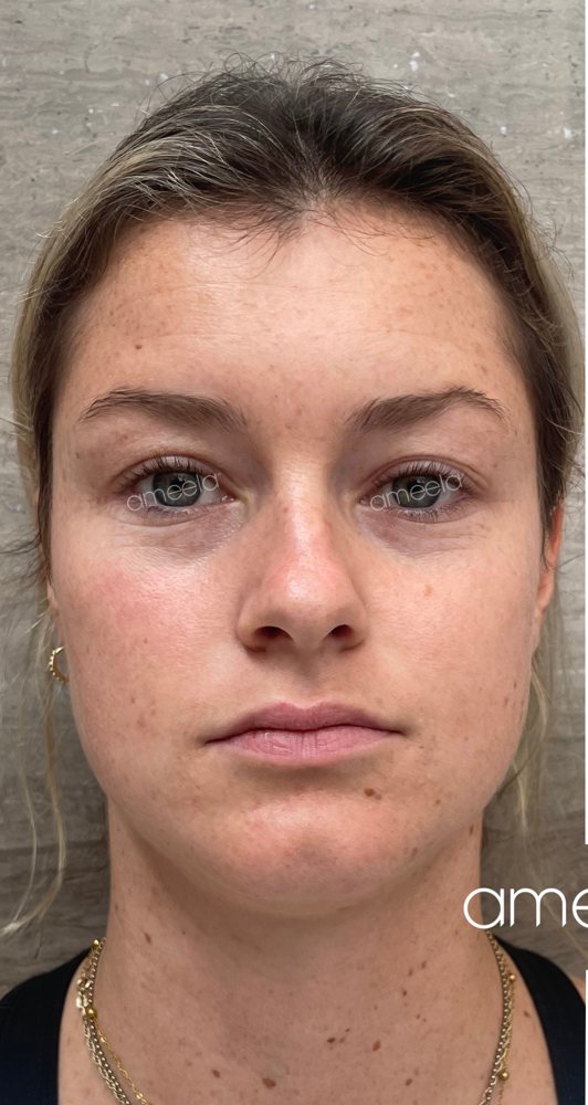 Before: Ameela Face · full face