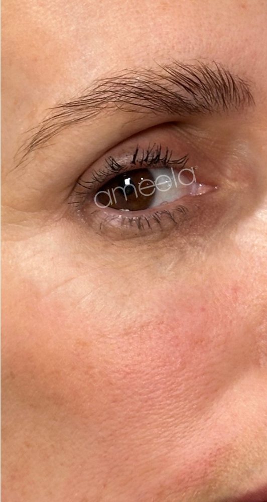 After: Ameela Rejuvenation · crow's feet