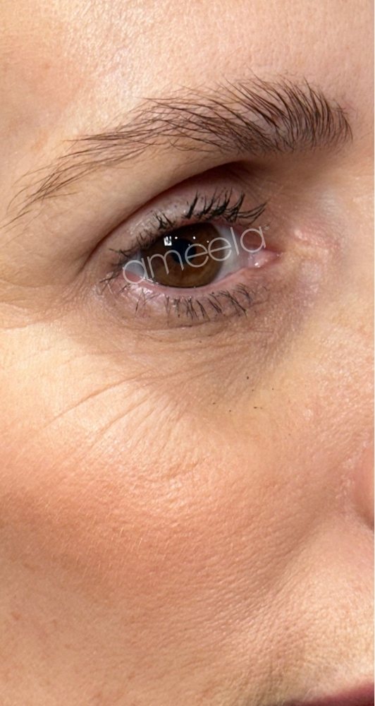Before: Ameela Rejuvenation · crow's feet